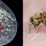 How Honeybee Venom Can Help Beat Breast Cancer