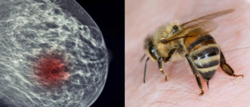 How Honeybee Venom Can Help Beat Breast Cancer