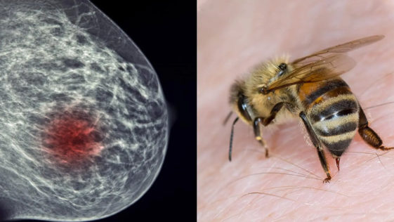 How Honeybee Venom Can Help Beat Breast Cancer