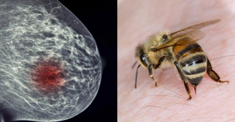How Honeybee Venom Can Help Beat Breast Cancer