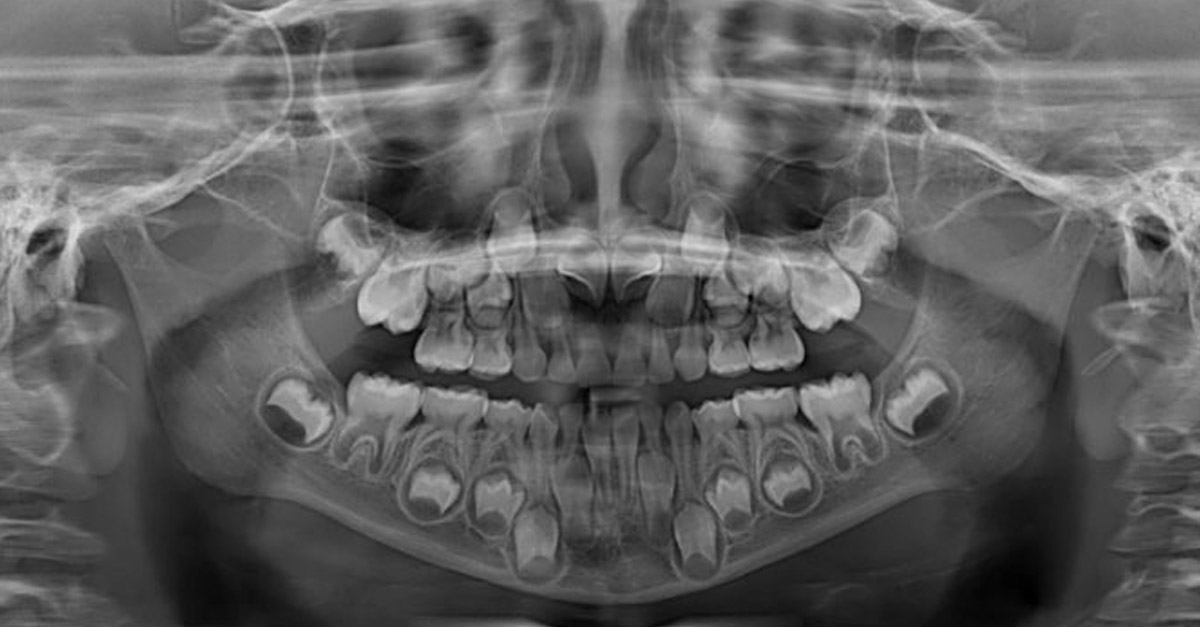 Amazing Child's Mouth X-Ray